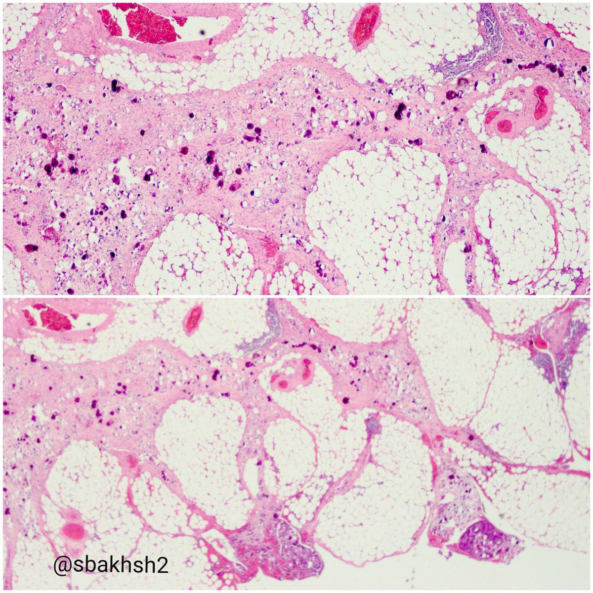 sbakhsh2's tweet photo. Omental &amp; peritoneal bxs :
🔬 invasive ovarian low grade serous carcinoma.
#Gynpath #pathology https://t.co/fkmT3xXtxw