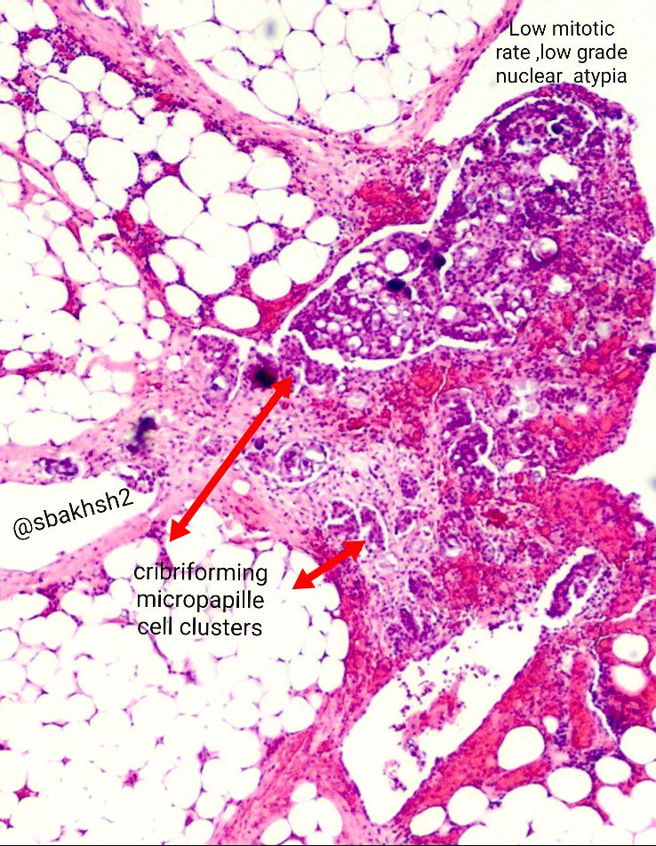 sbakhsh2's tweet photo. Omental &amp; peritoneal bxs :
🔬 invasive ovarian low grade serous carcinoma.
#Gynpath #pathology https://t.co/fkmT3xXtxw