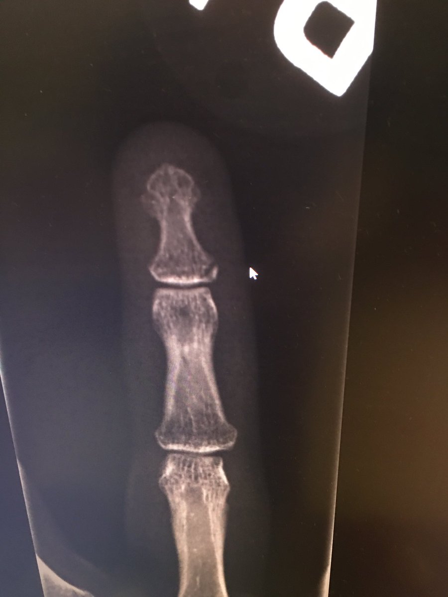Tattooedqueen19's tweet photo. Broken fingers aren't any fun!! Definitely need to invest in a bubble wrap shield!!! https://t.co/uhwZMIKo9G
