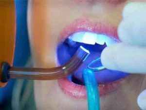 medicaldialogs's tweet image. #AAPGuidelines #DentalSedation #dentistry #pediatrics #anesthesiology @anesthesianews @AmerAcadPeds @AmerAcadPedDent @DentistryToday @AGDdentist @Duke_Anesthesia @JAMAPediatrics @DentistryIQ Updated AAP guidelines for safe dental sedation in children| Speciality Medical Dialogues