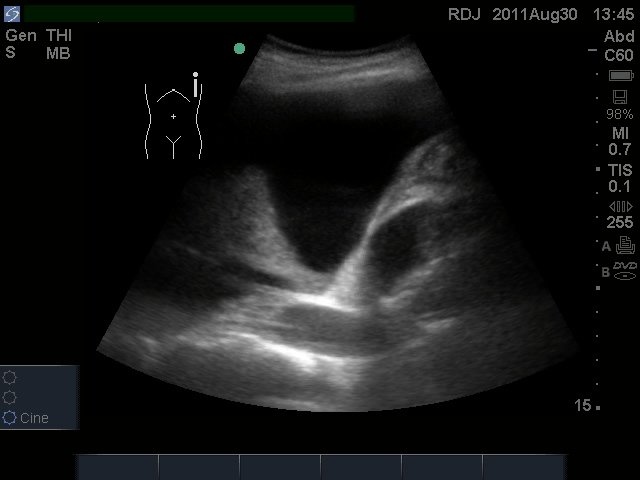 Bob Jarman (@bob_jarman) on Twitter photo New to point-of-care ultrasound? Still places on 1-day intro in Bristol <a href="/LifeCon999/">Life Connections</a> lifeconnections.uk.com/events/bristol… Ridiculously cheap price of £90 with hands on! For all clinicians who assess patients - doctors, nurses, paramedics, ODP, physio. Book at bookwhen.com/nemus/e/ev-s5q… #POCUS New to point-of-care ultrasound? Still places on 1-day intro in Bristol <a href="/LifeCon999/">Life Connections</a> lifeconnections.uk.com/events/bristol… Ridiculously cheap price of £90 with hands on! For all clinicians who assess patients - doctors, nurses, paramedics, ODP, physio. Book at bookwhen.com/nemus/e/ev-s5q… #POCUS