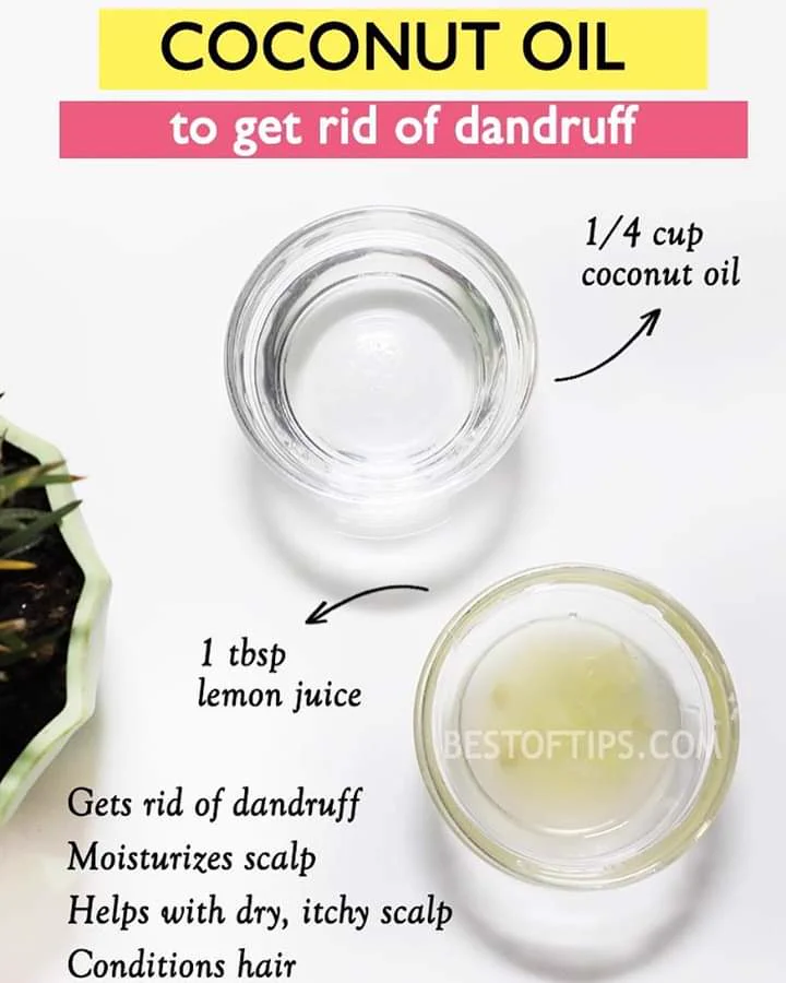 Why You Shouldn't Use Coconut Oil on Hair If You Have Dandruff