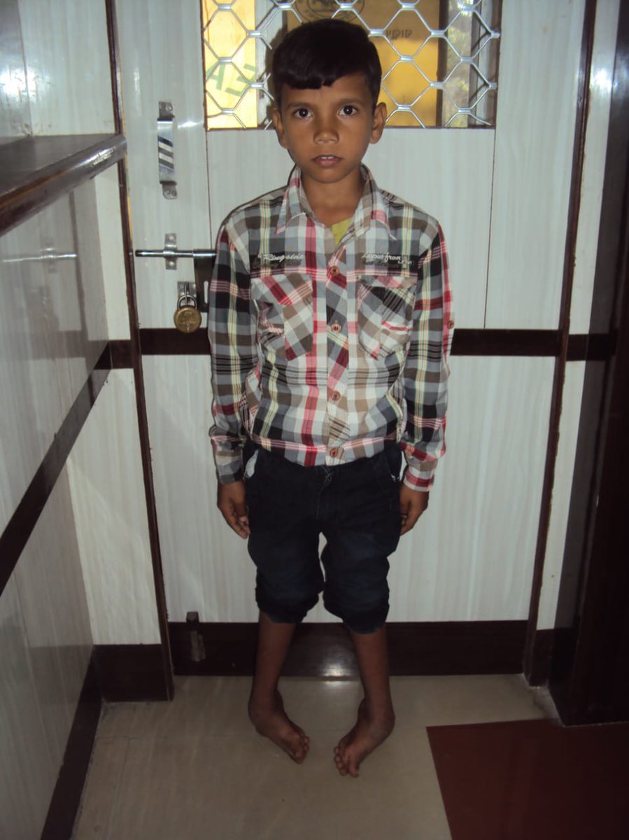 With joint efforts of CURE Clubfoot, Doctors and DEIC support, successful transformation of Satyananda from SVPPGIP DEIC clinic was possible. Now he is able to walk properly. #WorldClubfootDay #Health4All