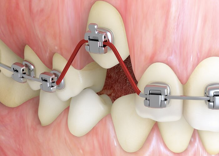 Autodesk_UKI's tweet photo. .@Smarter Alloys has made a significant leap forward in the world of dental alignment with #SmartArch, an orthodontic archwire made of a metal alloy called Multiple Memory Material. Find out more: https://t.co/A572PJN8Ct https://t.co/F28dB35wuA