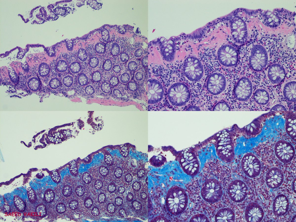 TexPathol's tweet photo. "Collagenous colitis- colon biopsy" in a 54 year old woman with watery diarrhea. Note the strands of collagen extending into the lamina propria from the basement membrane below the surface epithelium. #GIpath #TSPSpecialEdition. Case contributed by Dr. Saeed Vakili. https://t.co/4ceysIGuF6