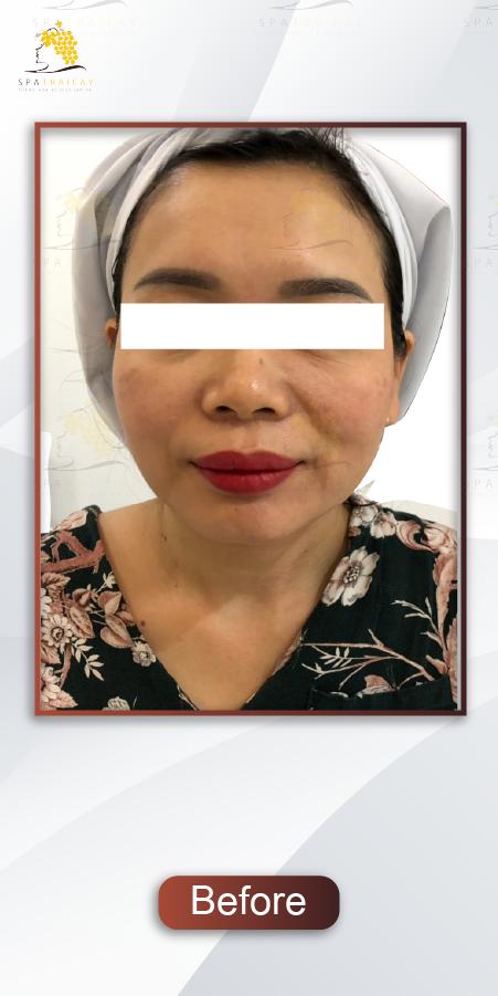 SpaTraicay's tweet photo. #ULTRAFACELIFT TRẺ HÓA LÀN DA
💯TRẺ HƠN 10 TUỔI CHỈ SAU 1 LIỆU TRÌNH💯
SPA TRÁI CÂY 🍏🍎🍊
💬 Inbox: https://t.co/qF7ZSPUnM6
🌐 Facebook: #spatraicay
☎ Hotline: 0915.011.661- 028.3526.0366
📍 Địa chỉ: 177 Trương Định, P.9, Q.3, Tp.HCM
🌐 Website: https://t.co/5NJJLVhU73 https://t.co/zmEzk1ShA3