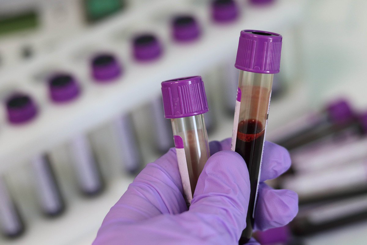 Did you know Anaemia is common in #kidneydisease?Kidneys secrete a hormone called erythropoietin, this controls the production of red blood cells in the bone marrow. In severe #kidneydisease, anaemia occurs because kidneys cannot make enough erythropoietin Info: <a href="/Kidney_Research/">Kidney Research UK</a>