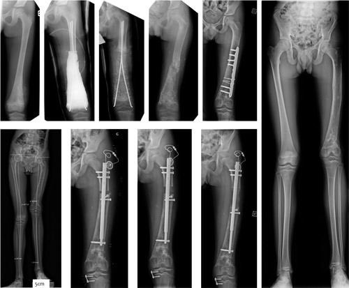 eposorg's tweet photo. Bone reconstruction after malignant tumour resection using a motorized lengthening intramedullary nail in adolescents.All JCO articles are #FREE to read online
https://t.co/8Q13nel1Eh
#childrensorthopaedics #bonereconstruction #surgery #orthopaedics #fractures #paediatricsurgery https://t.co/60SHjnBW5y