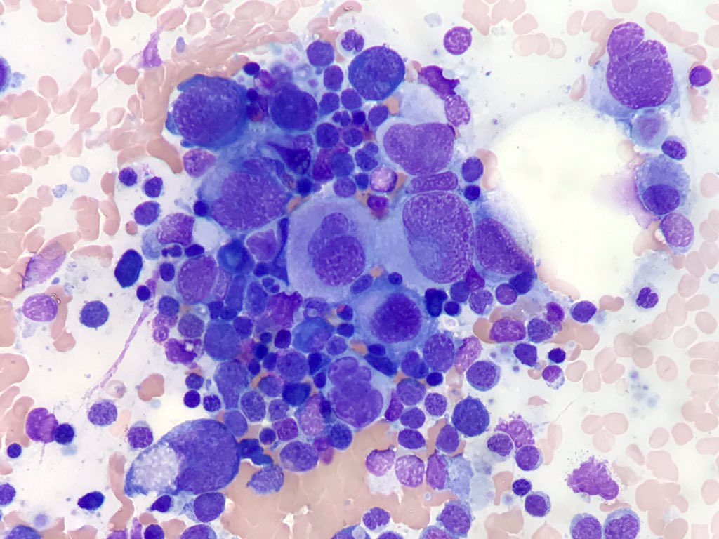 Fernando Martin Moro On Twitter 85 Yo Male Constitutional Symptoms Weight Loss And Fatigue Anemia And Neutropenia Bone Marrow Aspirate Shows Multilineage Dysplasia Images Cytopath Hemepath Mds 5q Megakaryocytic Dysplasia Https T Co