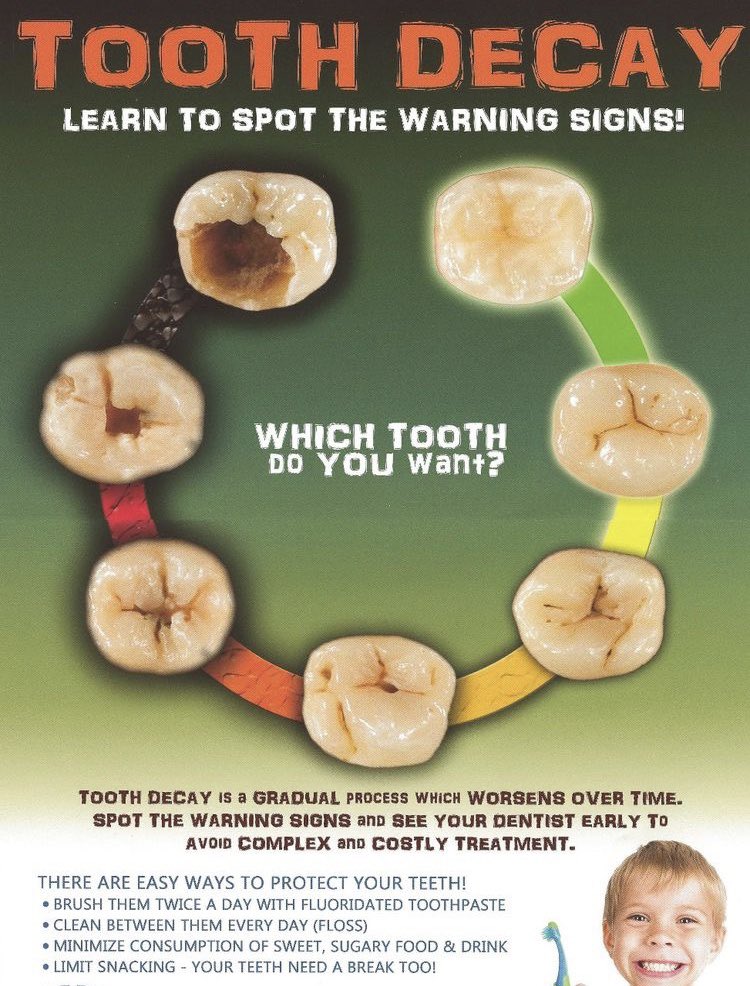 Call today! Tooth decay worsens everyday you wait! #dentalscreening #seeyourdentist #toothdecay #dontwait #cleaning #dentist #yikes #staygreen #hygiene