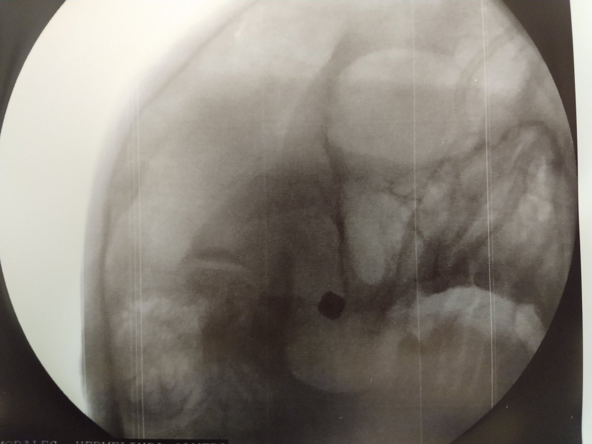 clinicadolorqro's tweet image. Radiofrecuencia del ganglio trigeminal. #neuralgiadeltrigemino #ElBlogdelDolor