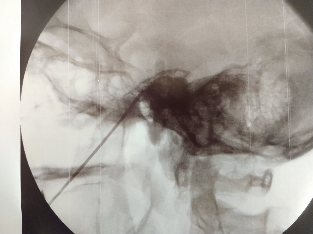 clinicadolorqro's tweet image. Radiofrecuencia del ganglio trigeminal. #neuralgiadeltrigemino #ElBlogdelDolor