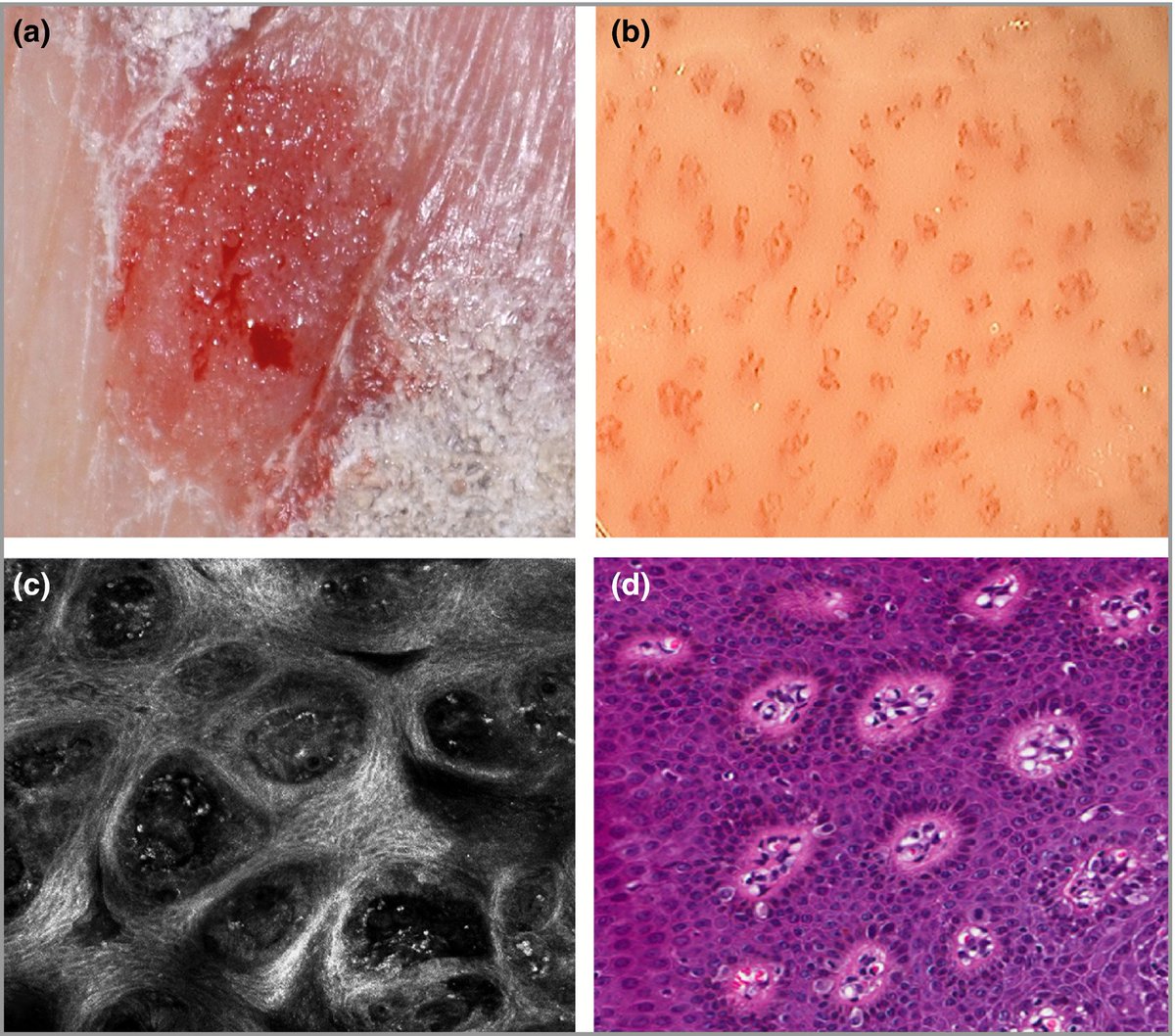 BrJDermatol's tweet photo. Check out this interesting #ImageGallery from our latest issue - using #videodermatoscopy, confocal #microscopy and horizontal #histopathology to reproduce the #Auspitz sign! https://t.co/zX4khfBxSr #BJD #Dermatology https://t.co/vxA7NBaQtv