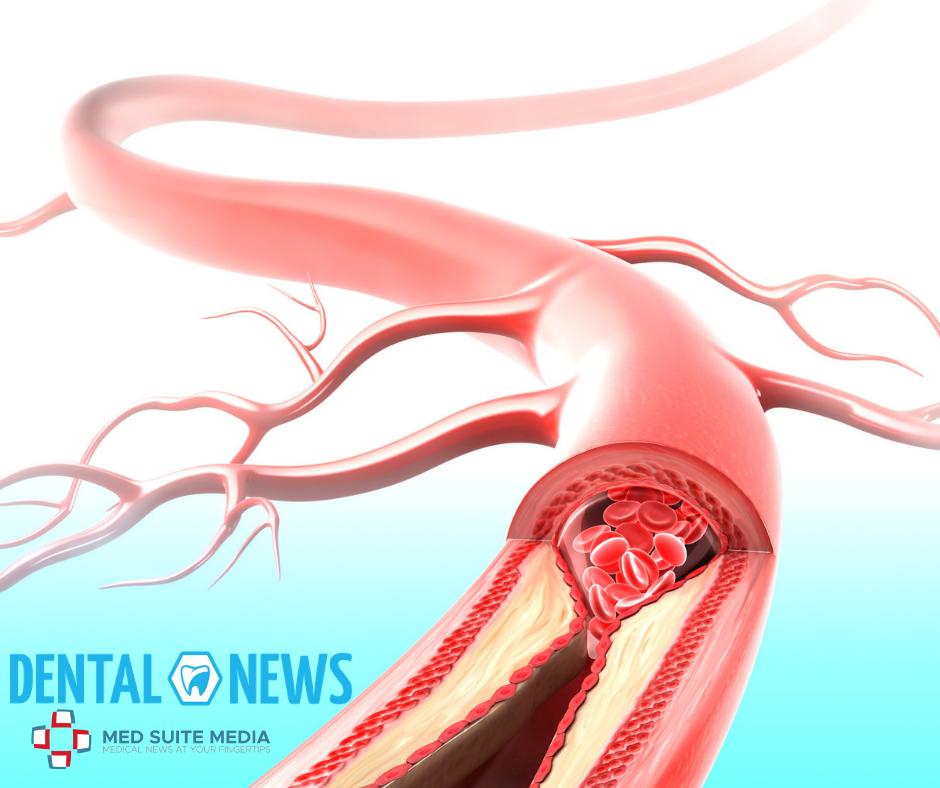 suite_med's tweet photo. Common oral infections in childhood may increase the risk of atherosclerosis in adulthood. Read more in issue 4 of Dental News: https://t.co/IshfsEvf9T via @suite_med 

#medsuitemedia #dentalnews #speciality #medicalnews #medicalarticles #infections #oral #adulthood https://t.co/HjiLqbL0Zg