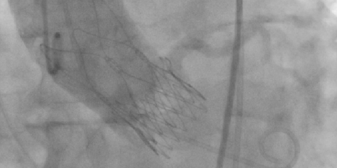 BSC_EU_Heart's tweet image. #TAVI Clinical Case: Risk for coronary obstruction? See a case of  #ACURATE neo confirming the 0% coronary obstruction rate in SAVI-TF real-world registry. bddy.me/2Kq0uhH