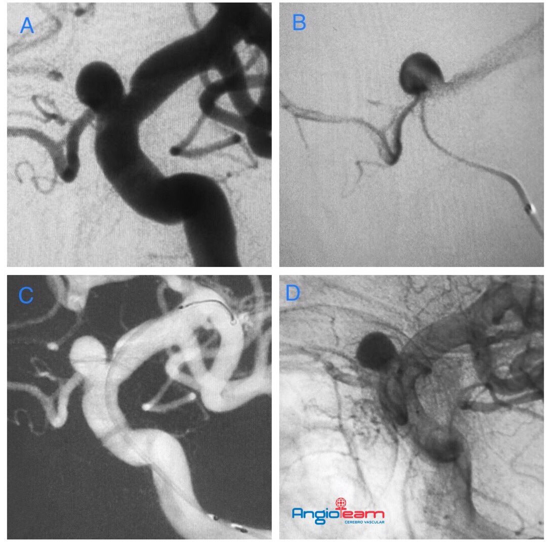 A. Angiografía muestra aneurisma de cuello ancho carótido oftálmico izquierdo. 
B. Angiografía selectiva muestra aneurisma comprometiendo arteria oftálmica.
C. Implantación de stent diversor de flujo 
D. Retención de contraste en el aneurisma post stent diversor de flujo.