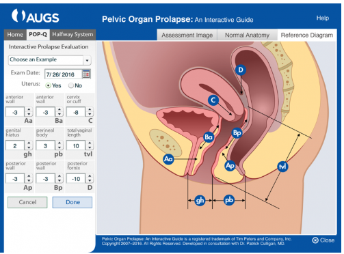 Have you checked out the AUGS interactive POP-Q assessment tool that helps you visually demonstrate pelvic floor exam results to your patients. Try integrating it into your practice today! ow.ly/vmKp50jvE0G