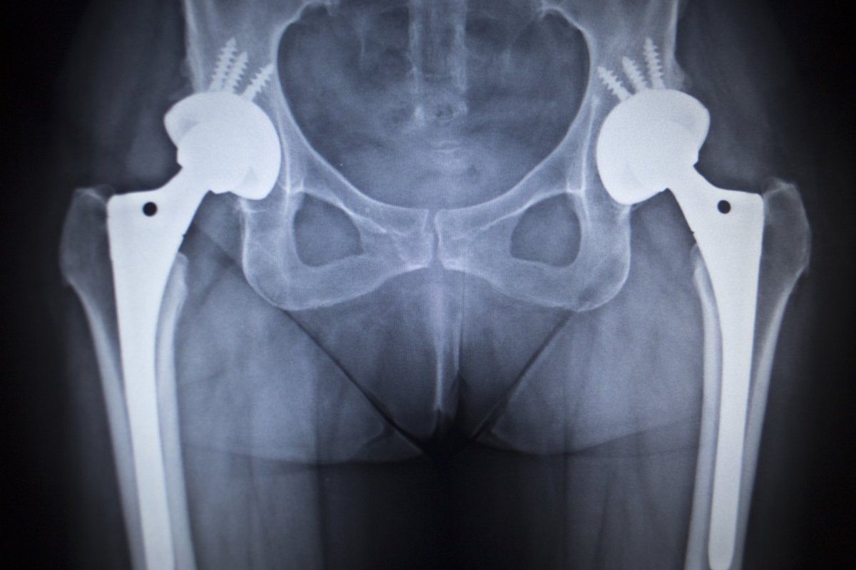 TopClassActions's tweet photo. A Minnesota couple has filed a Stryker LFIT lawsuit alleging the metal hip implant he received is defective, causing injury. Learn More: https://t.co/3IU7dTG4RK #hipreplacement #hipimplant #hipimplants #metalhips #medicaldevice https://t.co/yk7LHnJhZx