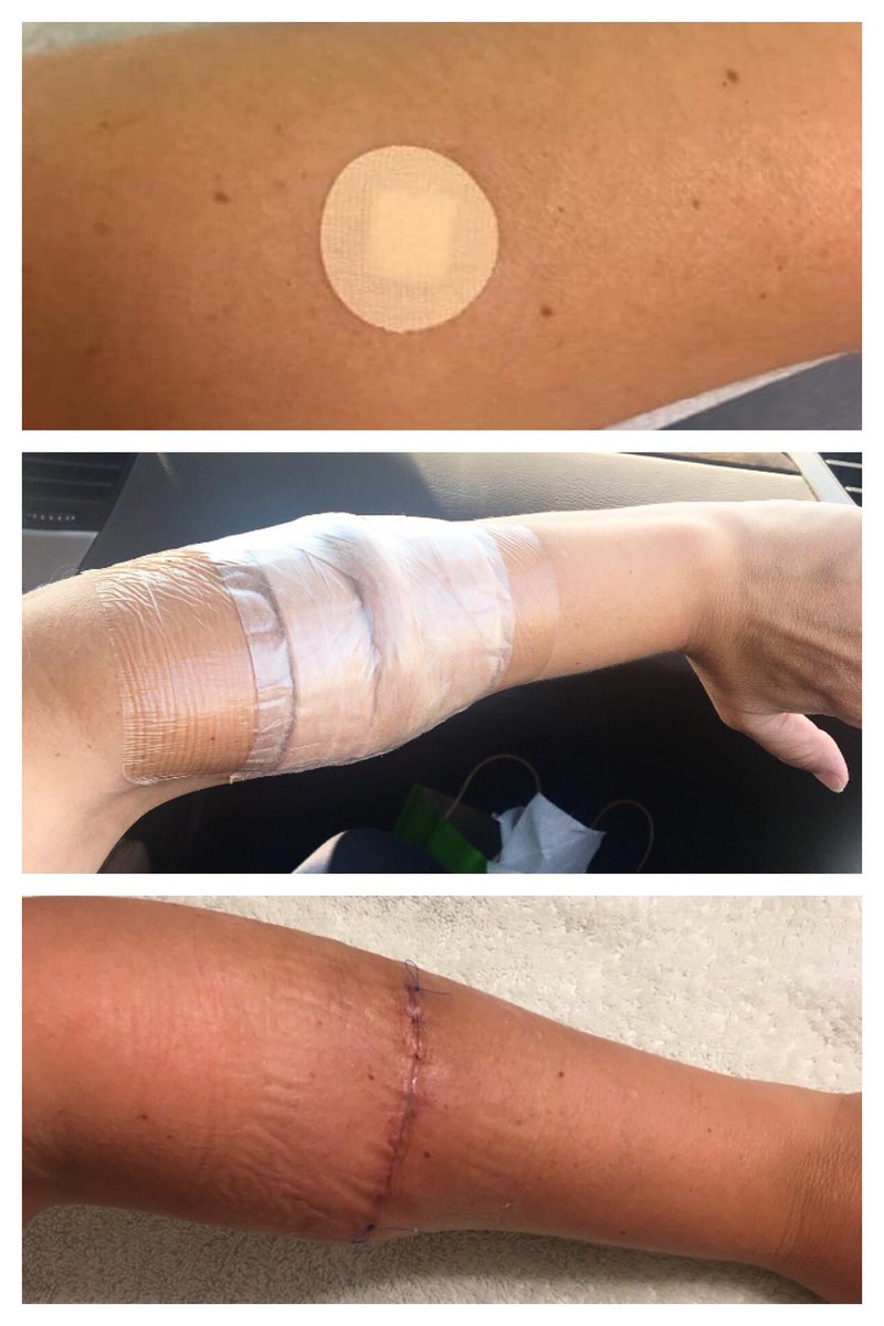 laurajernigan's tweet photo. Wear sunscreen, kids. #melanoma #checkyourbody #cancersucks https://t.co/sqUpDEoSZx