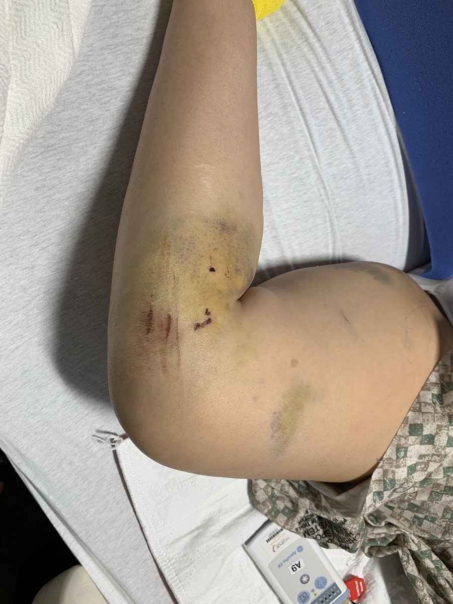 LyanaLove23's tweet photo. **** LOOK AT YOUR OWN RISK ****
After 11 days in the hospital due to having a broken lower back, nose, multiple bones in my foot, bruised lungs &amp; minor bruises &amp; cuts everywhere ... I am finally out ! Thank y’all for all the prayers. 🙏🏼❤️ https://t.co/wF3mvl57tN