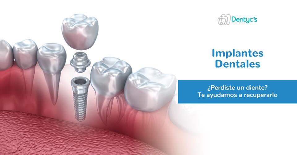 DentycsSc's tweet image. 🔷Perdiste un diente...🦷
En #Dentycs te ayudamos a recuperarlo de manera segura y sencilla para lucir una boca sana Contáctanos  y agenda tu cita 
📲por whatsapp 55 1289 1665
 ☎️Teléfonos: 55758217 y 55756702
🌐Visita dentycs.com
#implantedental CDMX , #dentista