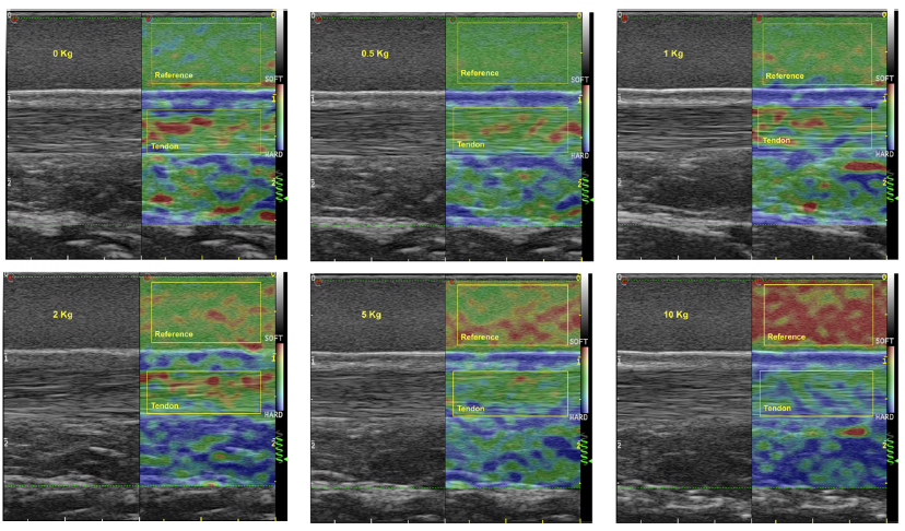 AleSchnee86's tweet photo. Achilles tendon elasticity changes detected by strain sonoelastography.
https://t.co/32cX5hWh0o
@jfootankleres 
Thanks to all the co-authors!  @MarcoBarberoFT @Deb_Falla @CorradoCescon
@supsi_ch @CprSpine @unibirmingham https://t.co/kucV0Le4Z5