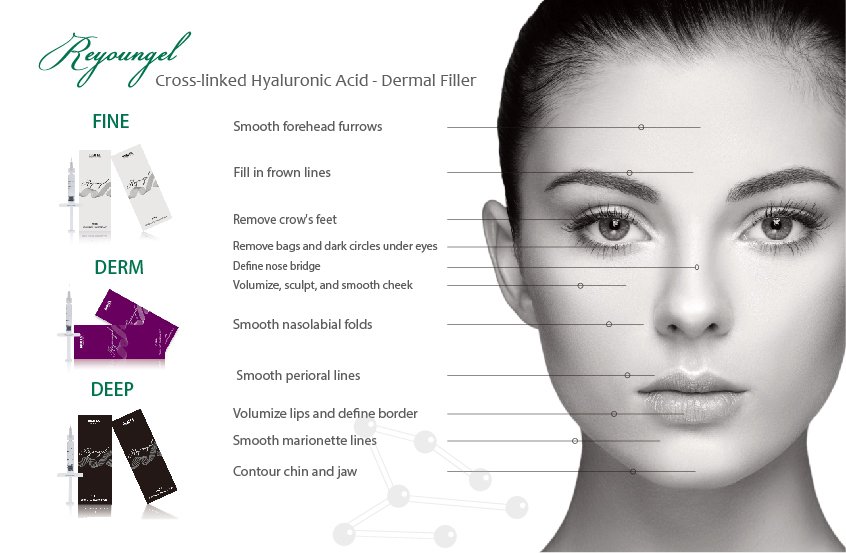 reyoungel's tweet image. Reyoungel dermal filler is from non-animal origin and high-purity, it can be well biodegraded in the skin. There is no side effect and less invasive, filling wrinkles and smoothing your skin without inhibiting facial expression.