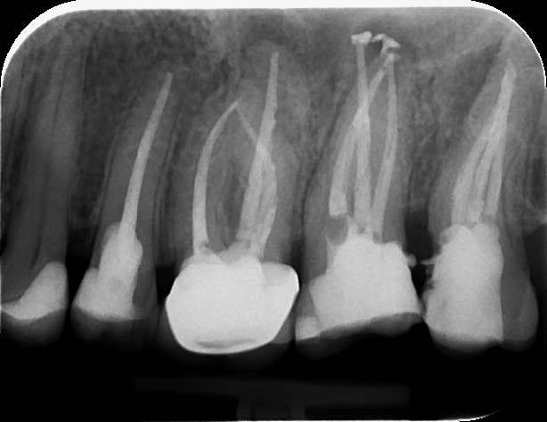 DENTSPLY_UK's tweet photo. “As a faculty member, I use instruments from various manufacturers, but at the private office, for me there is only ProTaper.” Dr Ivica Anic
#ProTaperStories
#ProTaperGold
#FormethereisonlyProTaper
#endodontics https://t.co/vksQw5Qwb2