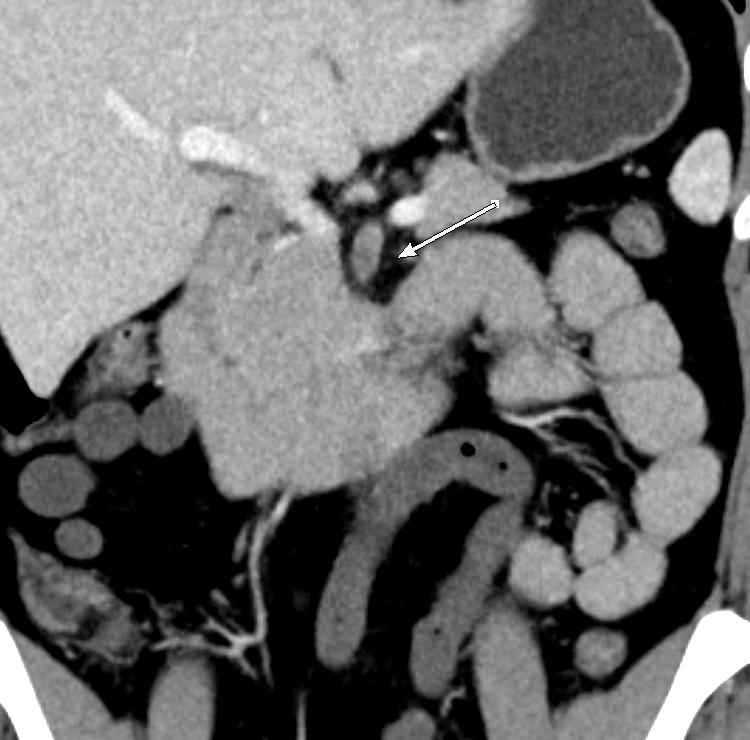 KhuranaBharti's tweet photo. Superior mesenteric artery thrombus with infarcted bowel. #radres look at the lack of bowel enhancement on #DECT even though there is no thickening or pneumatosis #radres #FOAMed #EMRad #radiology https://t.co/jtqmCN6NDT