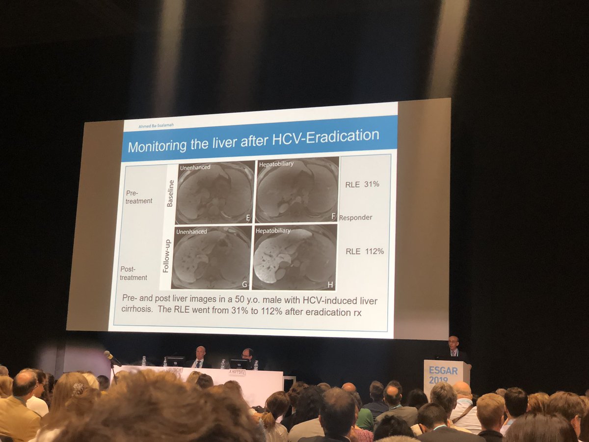 Fascinating to hear how an easy to use, qualitative scoring system is being implemented to assess hepatic function in Primovost MRI liver imaging. #esgar2019 #esgar #girad #radiology