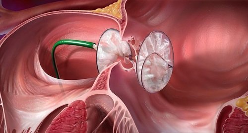 24marketreports's tweet photo. #Heart_Defect_Closure_Devices market will register a 9.3% CAGR in terms of revenue, the global market size will reach US$ 992.2 million by 2024, from US$ 635 million in 2019. To know more current market status of major Industry @ https://t.co/rUeIC2veHn https://t.co/dd5O4EER5e