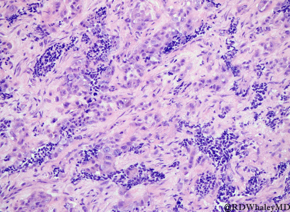 TexPathol's tweet photo. Melanotic Neuroectodermal Tumor of Infancy: Biphasic alveolar proliferation composed of small neuroblast-like cells and larger melanin-producing epithelioid cells separated by fibroblastic stroma. Presentation - first year of life. #Pedipath  #TSPSpecialEdition @RDWhaleyMD https://t.co/dORTFQr6k3