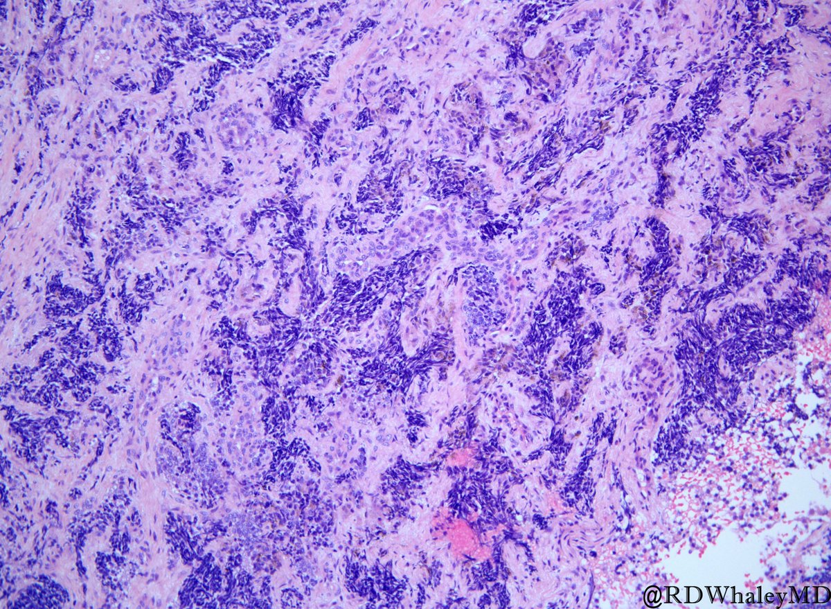 TexPathol's tweet photo. Melanotic Neuroectodermal Tumor of Infancy: Biphasic alveolar proliferation composed of small neuroblast-like cells and larger melanin-producing epithelioid cells separated by fibroblastic stroma. Presentation - first year of life. #Pedipath  #TSPSpecialEdition @RDWhaleyMD https://t.co/dORTFQr6k3