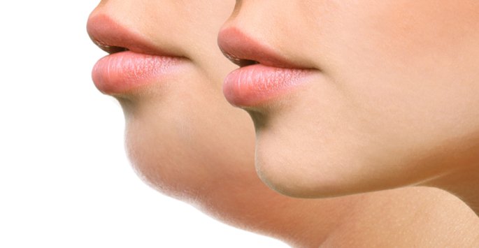 drjeneby's tweet photo. #ChinFat can be difficult to target with diet and exercise. #Kybella can https://t.co/lVJRAV6TXR https://t.co/UybTs98Tqg