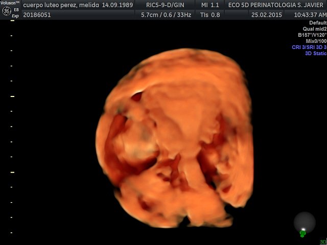 ceium's tweet photo. CEIUM en su conocimiento ecografico muestra caso Ginecologíco de cuerpo lúteo 5D https://t.co/Z0gG20dkDM