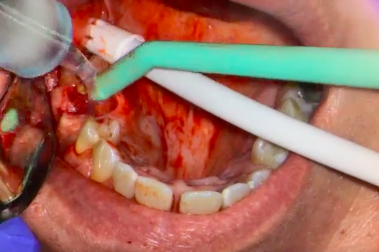 Have you seen our Extraction of Infected Root Canal &amp; Placement of Zirconia Implant procedure on YouTube? Check it out here: youtu.be/ld_T5CgVhSQ.