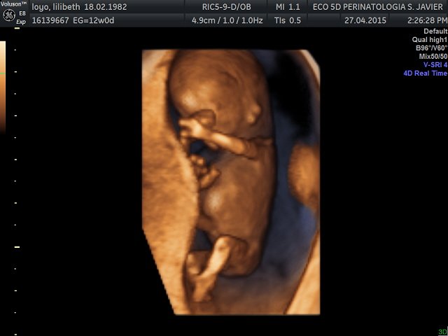 ceium's tweet photo. CEIUM cortes ecografico obstetricia de 12 semanas 5D https://t.co/DEMZYKjLdK