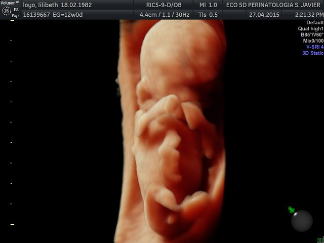 ceium's tweet photo. CEIUM cortes ecografico obstetricia de 12 semanas 5D https://t.co/DEMZYKjLdK