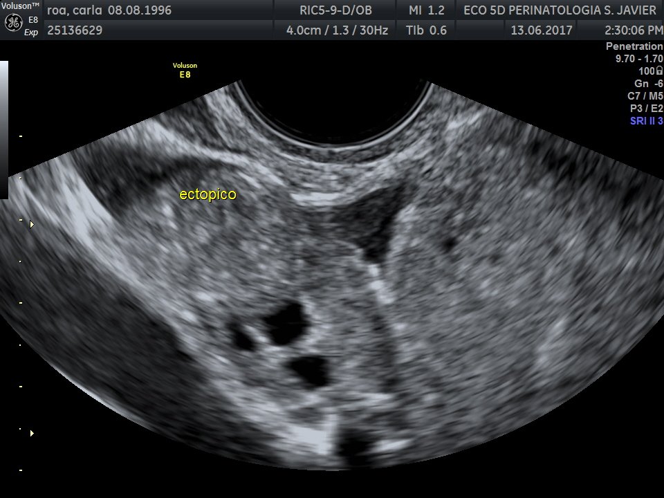 ceium's tweet photo. CEIUM CASO Embarazo Ectopico y Endometriosis https://t.co/99myOJAoDN