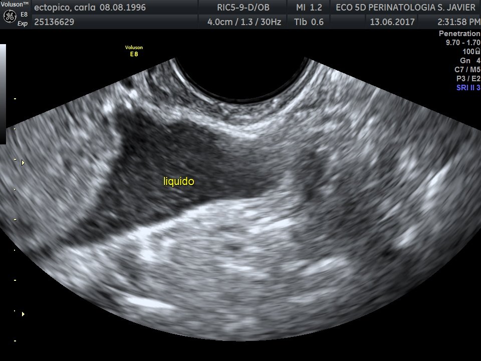 ceium's tweet photo. CEIUM CASO Embarazo Ectopico y Endometriosis https://t.co/99myOJAoDN