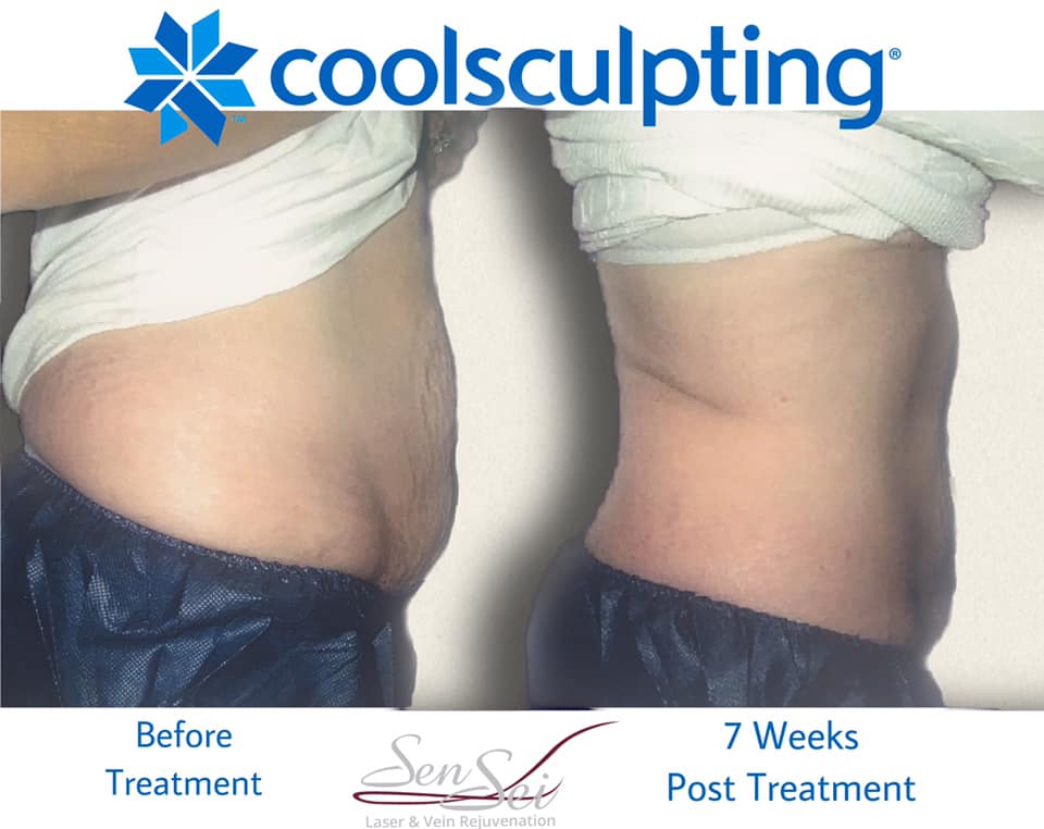senseilaser's tweet photo. A very happy CoolSculpting patient, 7 weeks post treatment!

Get rid of unwanted fat without surgery or downtime.
Call us to schedule a consultation! 250.768.5355 https://t.co/cq5uhhE2i6