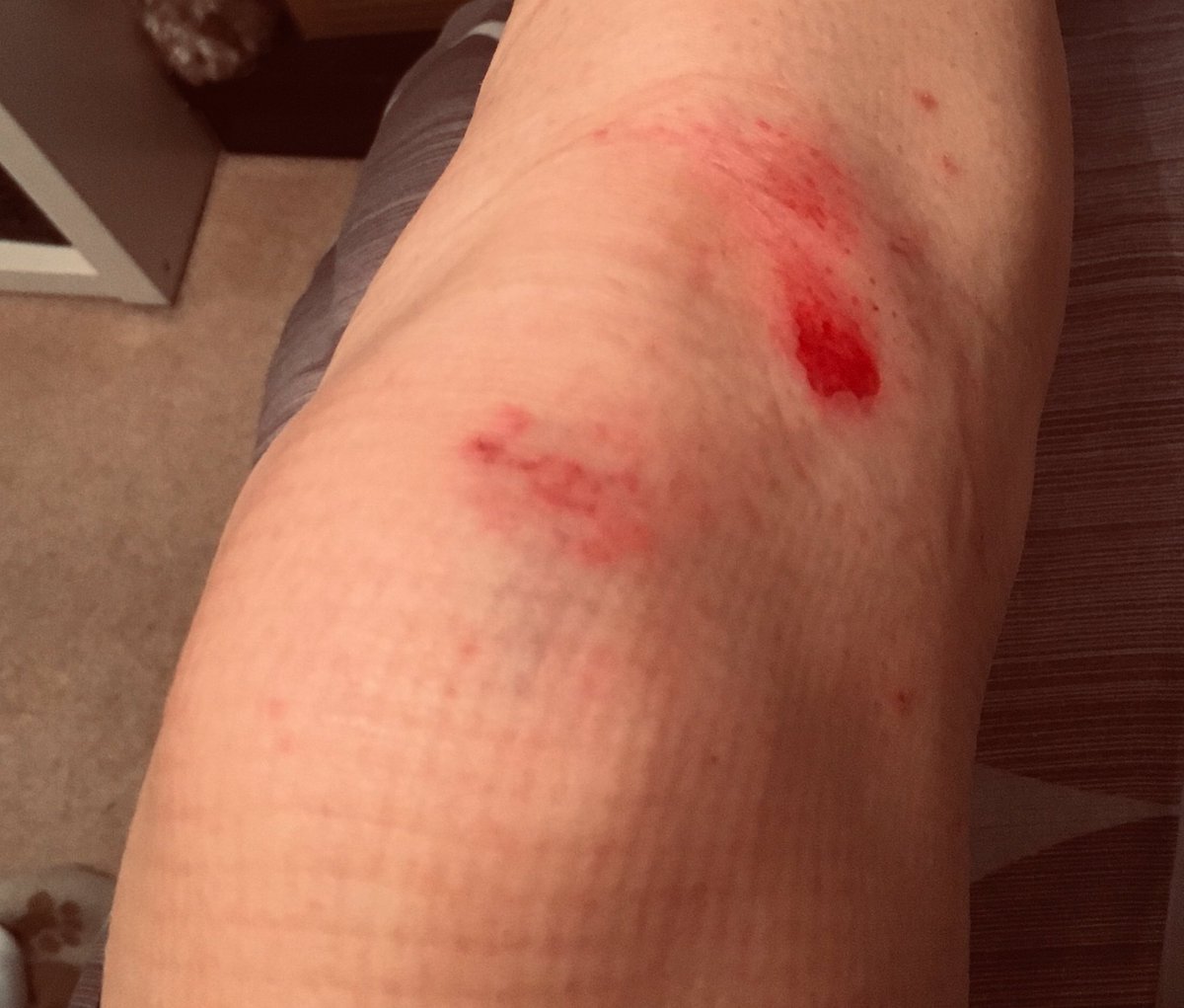 becks_bryant's tweet photo. When your brain and your legs are moving at a different pace to each other! #BaddieKnee #BatteredLegs #JustasWelliDontDoDressesOften #SheFellOver ππ€¦πΌββοΈπ³ https://t.co/FnTyRPQShS