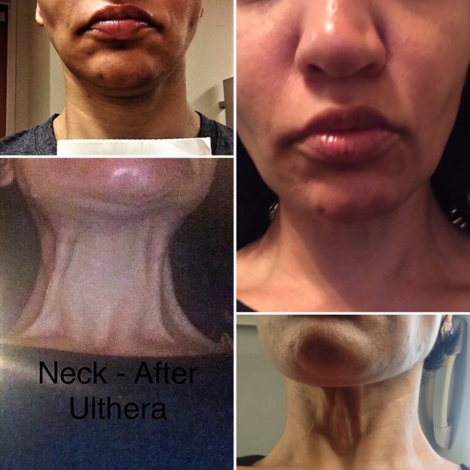 UltherapyDmg's tweet photo. This is damage from Ultherapy after treatment at DMH Aesthetics. Instead of taking resonsibility, I was accused of having body dysmorphia. Sadly I have to go through the rest of my life not being able to smile due to permanent nerve damage. #DMHaesthetics #Merzaesthetics #Ulthera https://t.co/fzFyuGtS4Z