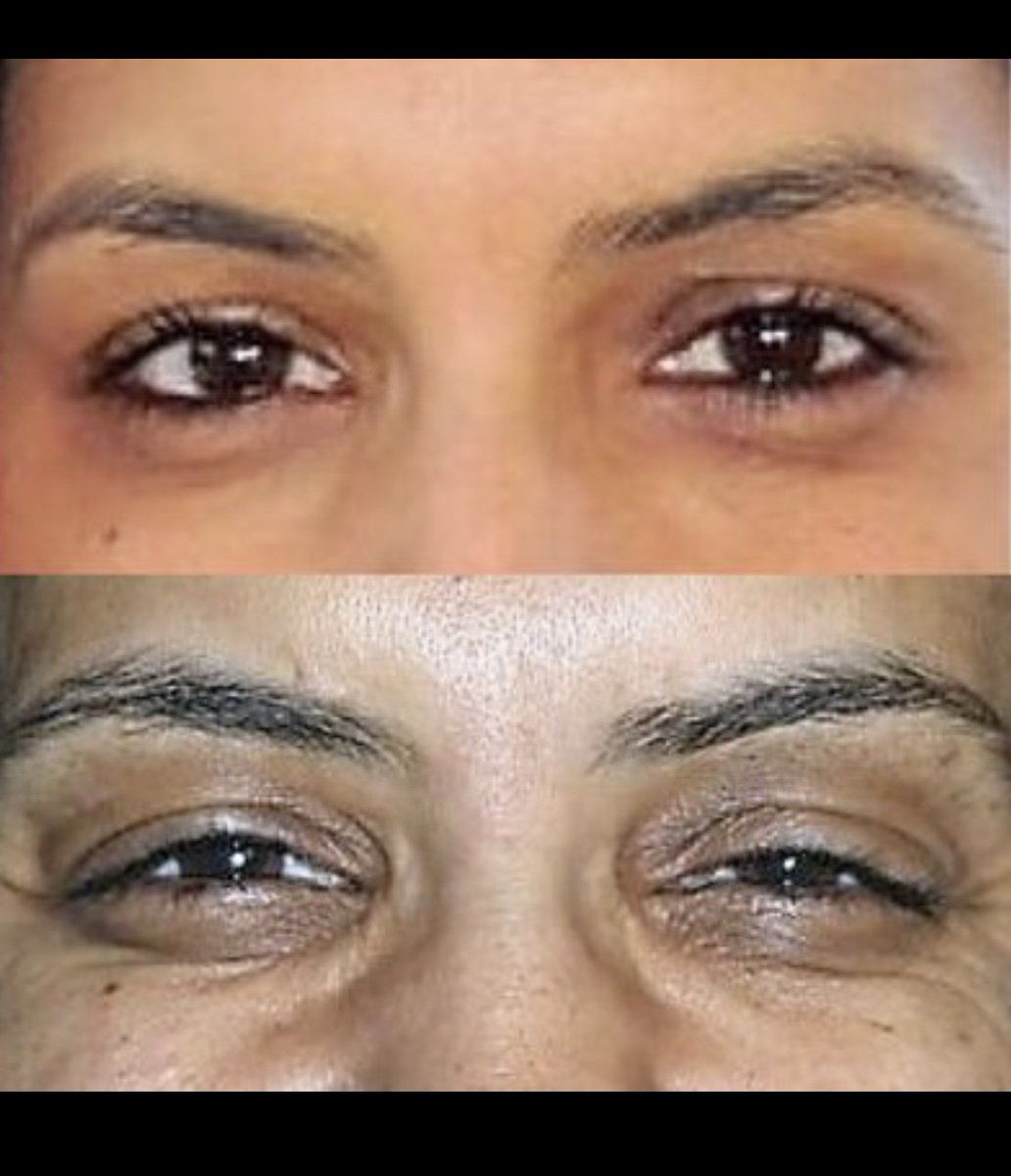 UltherapyDmg's tweet photo. This is damage from Ultherapy after treatment at DMH Aesthetics. Instead of taking resonsibility, I was accused of having body dysmorphia. Sadly I have to go through the rest of my life not being able to smile due to permanent nerve damage. #DMHaesthetics #Merzaesthetics #Ulthera https://t.co/fzFyuGtS4Z