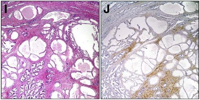 The article featured in the press release is "Syntaphilin Is a Novel Biphasic Biomarker of Aggressive Prostate Cancer and a Metastasis Predictor" new from authors at <a href="/YaleMed/">Yale School of Medicine</a>, <a href="/YaleCancer/">Yale Cancer Center</a>, and <a href="/TheWistar/">The Wistar Institute</a>.  Article is FREE as an Editor's Choice:  ajp.amjpathol.org/article/S0002-…