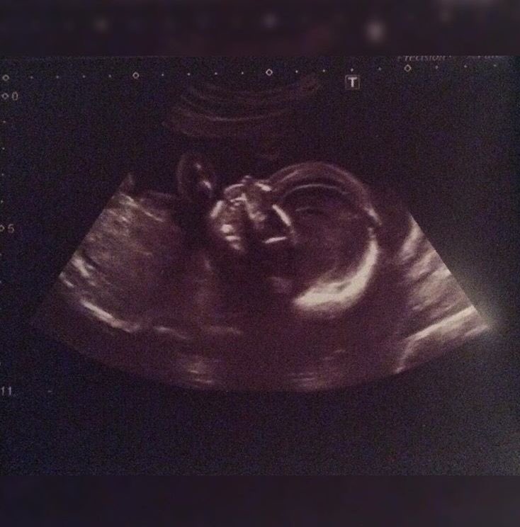 Francottam's tweet photo. 11 weeks 2 days until your due date, not long now baby girl. I can’t wait to see your beaut little face. You cheer me up so much before even meeting you - your little bendy back always makes me smile. 100% little miss awkward like mummy. I love you more than you’ll ever know🎀 https://t.co/AEcO2oLmZ5