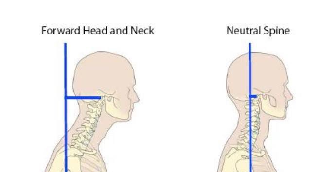 BodyMechanicsOC's tweet photo. Do you look down when you’re on your phone? You could be causing your #headaches and #migraines... 
https://t.co/GLRk5Xoy6q
#techneck https://t.co/ByTNKh5TTh