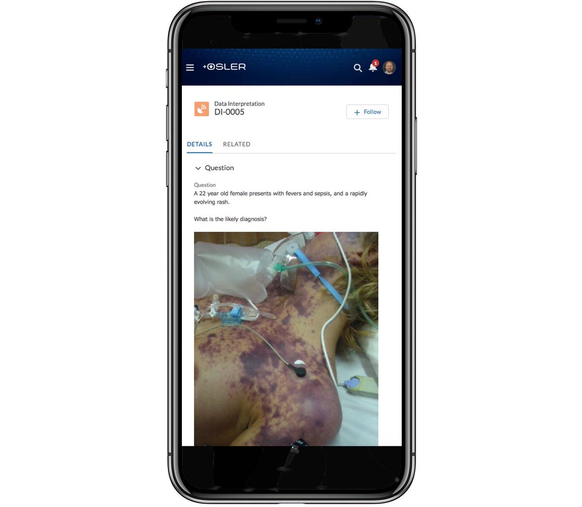 oslertech's tweet image. For this weekend only, if you&apos;re a CICM trainee at #cicm2019asm you can get 50% off a premium Osler subscription - that&apos;s HALF PRICE!

Use promo code CICMASM2019 when you subscribe

Support groups, exam banks, data interpretation, support groups and more!

osler.force.com/criticalcare/