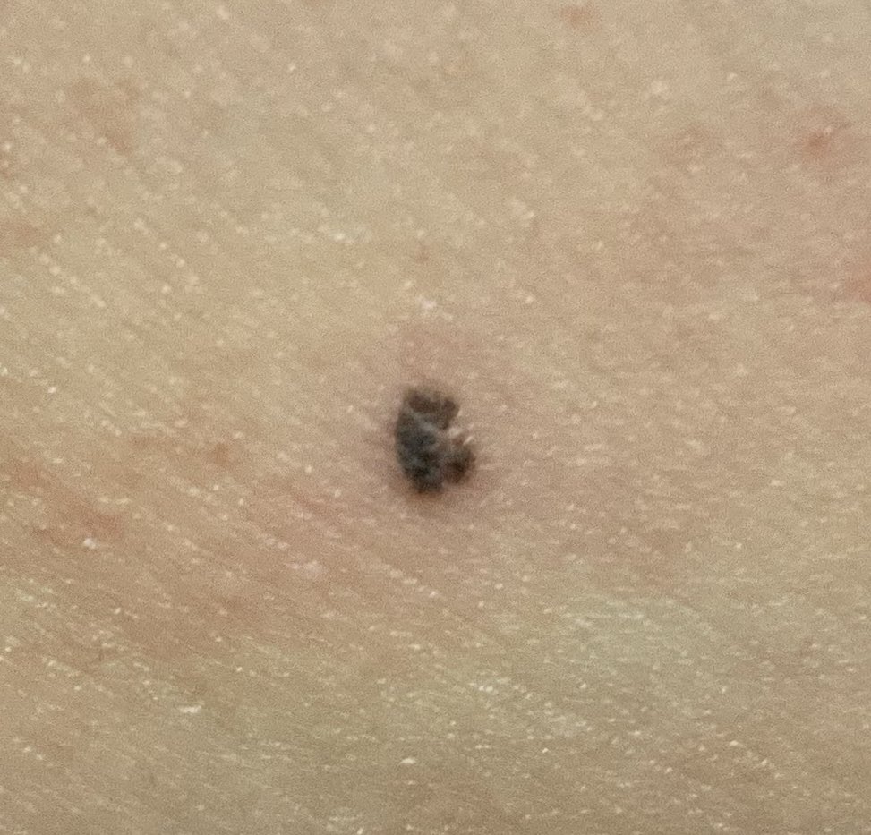 鈴神小鳥 Unityでadv なつのね 開発中 Pa Twitter 実は先月手術してました メラノーマ 皮膚ガン の疑いで皮膚生検して本日結果が出ました 脂漏性角化症 良性 いわゆる老人イボ 老 人 イ ボ 代 Twitter