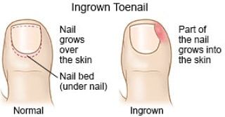 TheFootGroup's tweet photo. Ingrown toenails causing you a problem? We are here to help! Check out our article on expert treatment of ingrown toenails. Link in bio. https://t.co/3da740AP2G

#foot #feet #footpain #kidsfeet #podiatry #kidspodiatry #childrenspodiatry #ingrowntoenail … https://t.co/aWUgBSnjna https://t.co/Ddfsn2b8io